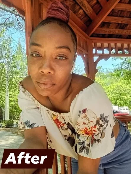 Joven recuperada después de quemaduras