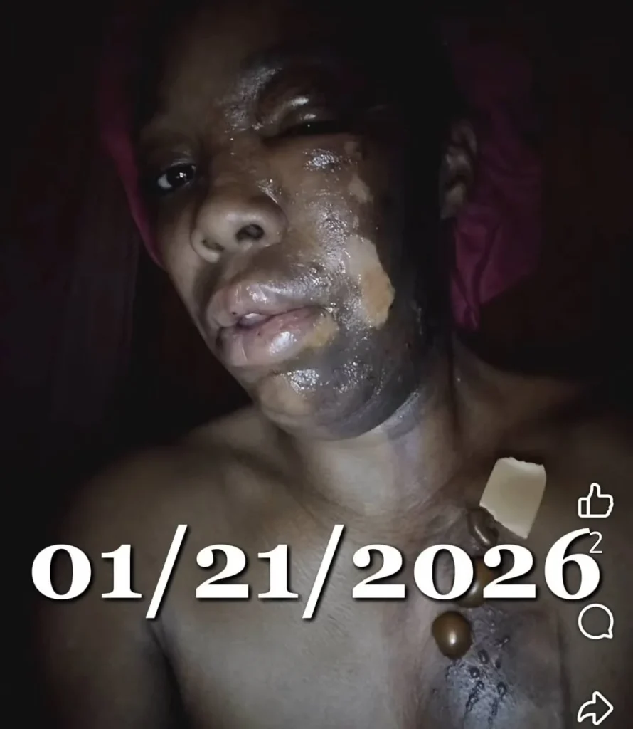 Joven con cara quemada